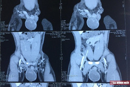 Lấy vợ một năm chưa có con, chàng trai ngã ngửa khi biết không có tinh trùng