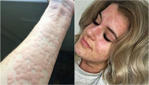 Kỳ lạ cô gái bị nổi mề đay khắp người hễ gặp lạnh