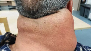 26 năm uống rượu thay nước, người đàn ông thành ‘quái vật’ với chiếc cổ kỳ dị