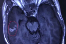 Sán dây 10cm ngoe nguẩy trong não chàng trai trẻ ở Trung Quốc