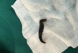 Bác sĩ gắp con đỉa trong họng người phụ nữ ở Hà Giang lên báo thế giới