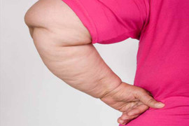 10 dấu hiệu của bệnh béo phì bạn nên biết