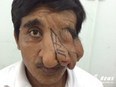 Chàng trai Khmer có khối bướu kỳ dị lủng lẳng gần 20 năm trên khuôn mặt