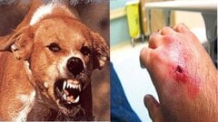 Bị chó cắn chủ quan không tiêm phòng, bác sĩ thú y chết thương tâm