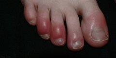 Mách nhỏ mẹo chữa bệnh cước tay chân vào mùa đông rét đậm, rét hại