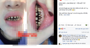 Rùng mình hình ảnh hàm răng bị biến dạng sau khi bọc răng sứ