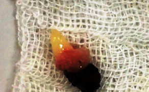 Hi hữu bệnh nhân nữ có răng 2 cm mọc trong lỗ mũi