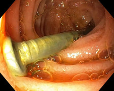 Bé trai suýt mất mạng vì nuốt phải chiếc đinh dài 3 cm