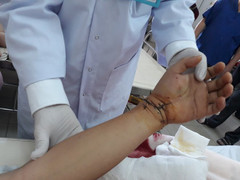 Bảo quản trong đá lạnh, bàn tay trái bị đứt lìa được ghép nối thành công