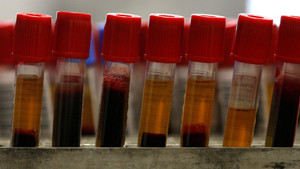 Xét nghiệm máu và nước tiểu có thể phát hiện chứng tự kỷ ở trẻ em