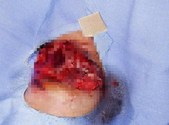 Bé gái 13 tuổi dập phổi, nát cánh tay do pháo nổ