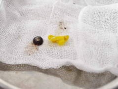 Mắc pin, dây buộc tóc trong mũi, bệnh nhi suýt thủng vách ngăn