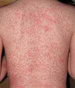 Hà Nội: Số ca mắc bệnh sởi ngày càng gia tăng