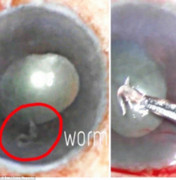 Rùng rợn hình ảnh ký sinh trùng sống trong mắt người phụ nữ Ấn Độ