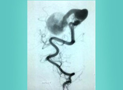 Bệnh nhi bị teo não do căn bệnh dị dạng mạch máu não bẩm sinh hiếm gặp