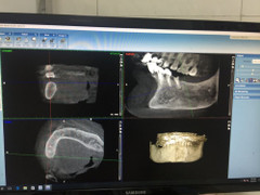 Hy hữu: Cấy ghép răng cho cụ bà 91 tuổi với nhiều bệnh lý phức tạp