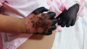 Xót thương bé gái bị hoại tử tứ chi do mắc bệnh hiếm gặp