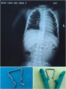 Hi hữu: Phát hiện đoạn dây inox sắc nhọn trong bụng bé trai 18 tháng