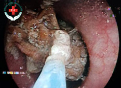 Miếng gân bò 'nằm lì' trong thực quản cụ ông 88 tuổi