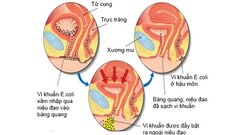 Bệnh nhi 6 tuổi đi tiểu nhiều lần do nhiễm khuẩn E coli