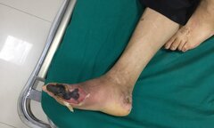 Kinh hoàng biến chứng tiểu đường đâm đinh vào chân không biết đau