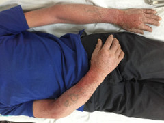 Ngứa, bong tróc da toàn thân có rỉ nước vàng do đi cắt cỏ cho trâu