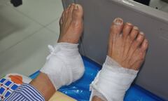 Chườm nóng bằng lá ngải cứu giúp giảm chứng tê bì chân, người đàn ông 60 tuổi bỏng nặng