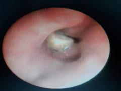 Cụ bà 84 tuổi suýt chết vì miếng hạt sen trong bát cháo tổ yến