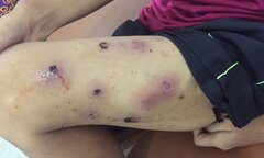 Rùng mình bé gái 12 tuổi toàn thân đầy mụn mưng mủ, ứa máu vì mắc bệnh này