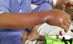 Đi cắt cỏ cho cá, cánh tay người đàn ông bất ngờ lên mụn mủ sưng phù