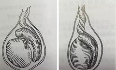 Xoắn tinh hoàn khi ngủ, cẩn thận mất cơ hội làm bố