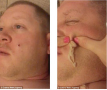 Video: Rùng mình cảnh vợ nặn mụn khổng lồ trên mặt chồng