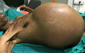 Chấn động: Người đàn ông 'mang thai' khối u mỡ nặng 20kg