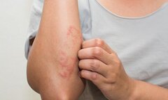 Phát hiện mới trong chữa trị bệnh viêm da cơ địa cho hàng triệu người