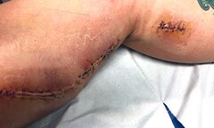 Vi khuẩn ăn thịt người 'đục' lỗ to bằng nắm tay trên chân thiếu nữ