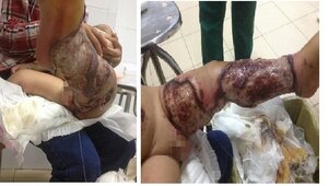 Bị bỏng nước sôi, bé 11 tháng tuổi chết do nhiễm trùng đường huyết nặng