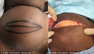 Người đàn ông có khối u mỡ khổng lồ như quả... bowling trên cổ