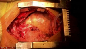 Hy hữu: Người đàn ông có tới hai quả tim cùng đập một lúc