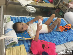 Điều trị thành công cho cháu bé chữa thuốc đông khiến cánh tay bị dính vào sườn