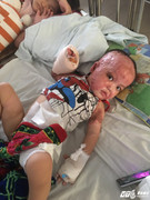 Nạn nhân tố bị 'thầy lang' chữa bỏng bất thành: Di chứng nặng nề, phải phẫu thuật nhiều lần