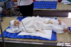 Thương tâm cháu bé bị bỏng nặng do ngã vào nước tẩy nhà vệ sinh