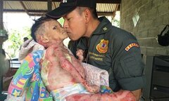 Cô bé mắc căn bệnh ‘da bướm’ hiếm gặp, 50.000 người mới có một người mắc