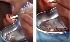 Kinh hoàng cảnh bác sĩ gắp hàng chục con giòi ra khỏi tai cậu bé