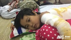 Dùng xăng châm lửa nấu cơm, một bé gái bị bỏng nặng