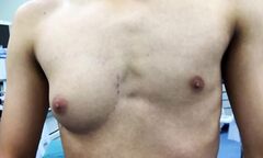 Chàng trai có 'ngực phụ nữ' nghi do ăn quá nhiều thức ăn nhanh