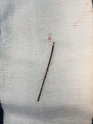 Hy hữu: Phát hiện cây kim 4 cm trong lồng ngực bé gái 3 tuổi, do bị ngã từ 2 năm trước