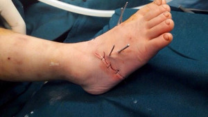 Bé trai bị máy làm miến cuốn gần đứt lìa bàn chân