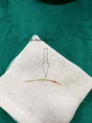 Ăn cá hóc xương, cụ già 72 tuổi bị thủng ruột