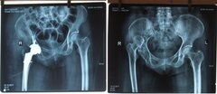 Bệnh nhân 48 năm ‘chân ngắn, chân dài’ được phẫu thuật thay khớp háng thành công
