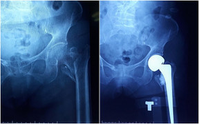 Cụ bà 102 tuổi được thay khớp háng nhân tạo thành công